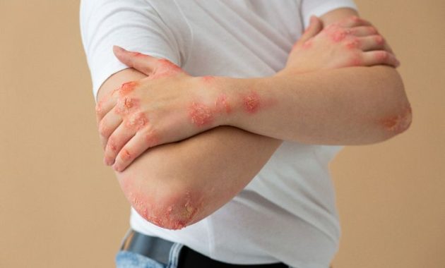 Gatal di Musim Dingin? Ini 6 Cara Efektif Mengatasi Alergi Dingin